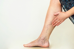 Varicose Veins Treatment in Indore Dr Nishant Khare